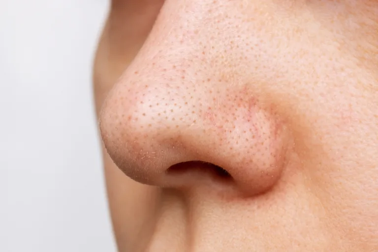 Types of acne: From clogged pores to cysts 3 Usa People Types of acne: From clogged pores to cysts