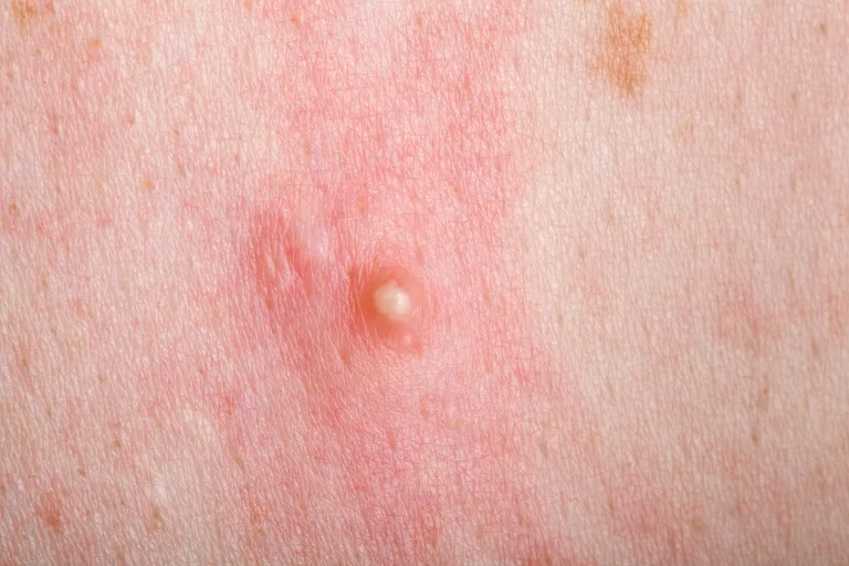 Types of acne: From clogged pores to cysts 4 Usa People Types of acne: From clogged pores to cysts